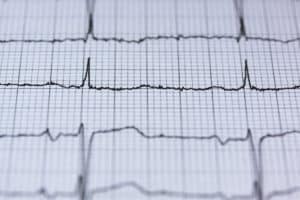 4 Steps to Take If Your Heart Surgery Failed