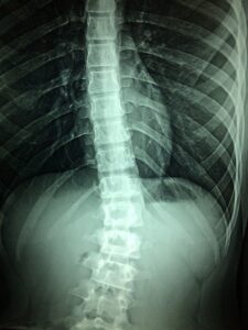 What Kinds of Damages Can a Spinal Cord Injury Lawyer Help Clients Seek?